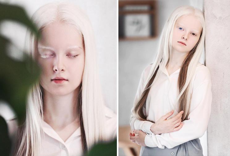 Амина Эпендиева, ребенок-альбинос
