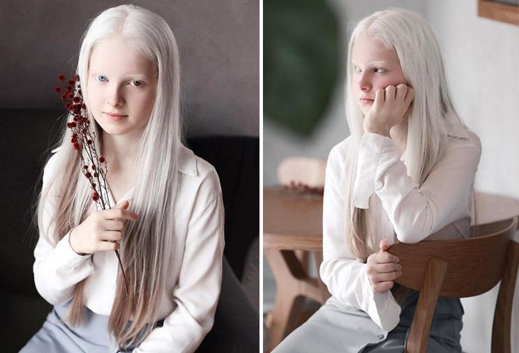 Амина Эпендиева, дитя-альбинос
